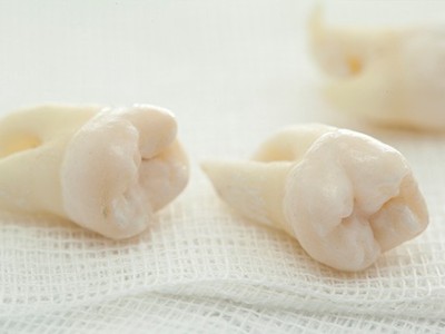 智齒疼了，這牙非拔不可嗎？