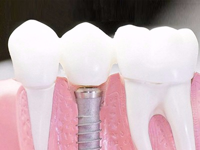 在承德口腔種植齒需要多少錢(qián)？惟德口腔一一為您道來(lái)